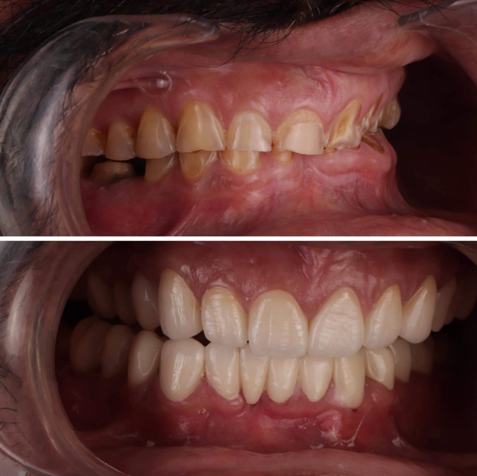 Before and after front view full mouth rehabilitation with combined restorative dentistry