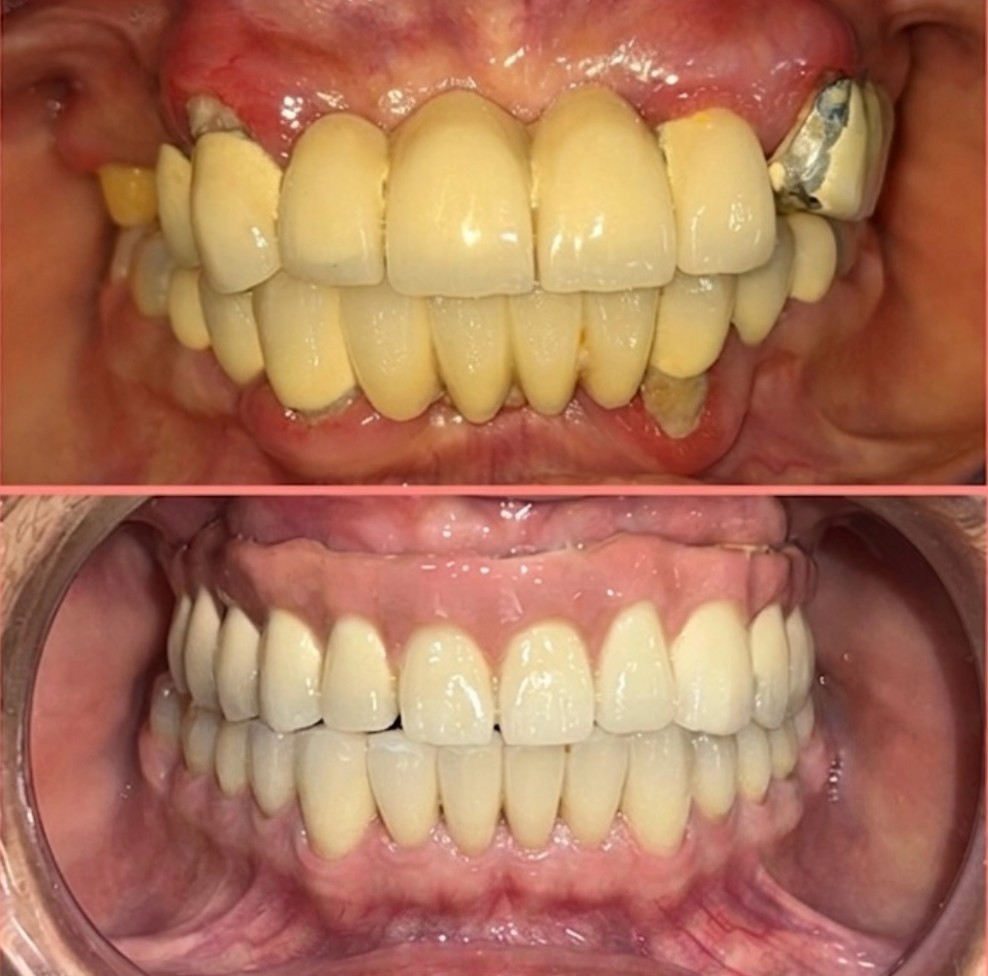 Before and after upper arch implant-supported fixed prosthesis treatment