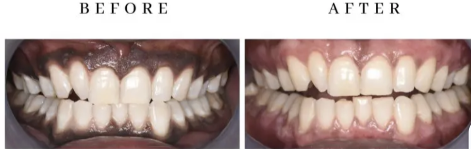 Gum depigmentation before and after comparison at Dentaura