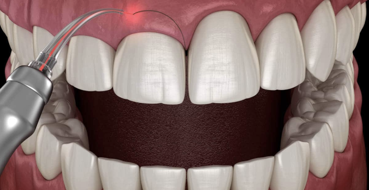 Laser gum surgery treatment at Dentaura